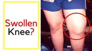 What to do with swollen knee joint injury that causes swelling inflammation and knee pain [upl. by Primrosa141]