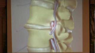 Lumbar Spinal Stenosis Part 2  Treatment Options Paul Houle MD [upl. by Sammy]