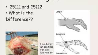 Hand Wrist Pain Hand Wrist and Finger Surgery Procedure [upl. by Lednew]