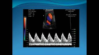 Obstetric Doppler Part 1 [upl. by Mast404]