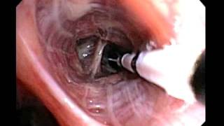 Bronchial Thermoplasty Improved Asthma Control for your Patients [upl. by Honebein]