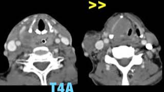 TMT Laryngeal cancer imaging by Dr Abhishek Mahajan [upl. by Devinne836]