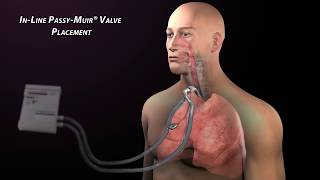 Passy Muir Valve with Mechanical Ventilation [upl. by Imim882]