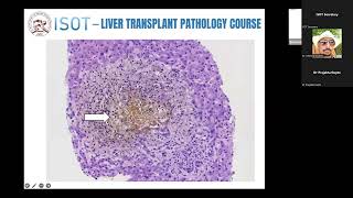 Ductal Pathology amp HLA and DSA [upl. by Benoite]