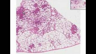 Histopathology LungBronchopneumonia [upl. by Anirazc105]