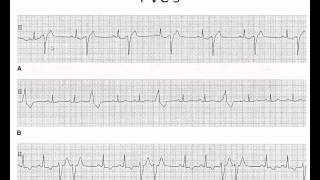 Easy EKG Premature Ventricular Contractions and Atrial Fibrillation [upl. by Enirhtac]