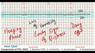 CTG Loss of Variability [upl. by Trevorr]