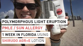 Polymorphous Light Eruption PMLE Sun Allergy  1 week Florida experiment with Shirudo AGRE [upl. by Ibbor]