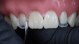 Peg Laterals Restorations with Rhodri Thomas BDS [upl. by Grimona]