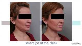 Double Chin Liposuction With Smartlipo™  Dr Sterry Explains [upl. by Lise]