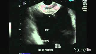 Ultrasound video of cystitis cystica [upl. by Ailecnarf835]