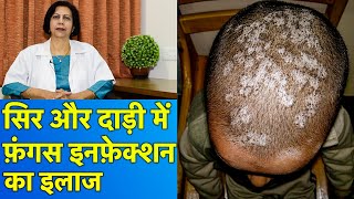 सिर और दाड़ी के फ़ंगस इनफ़ेक्शन का इलाज  Treatment of Fungal Infections In Beard amp Scalp [upl. by Natty]