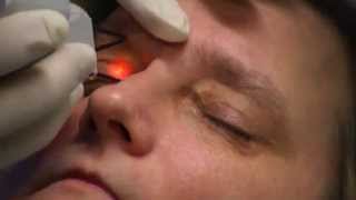 Xanthelasma laser treatment [upl. by Yrrad]