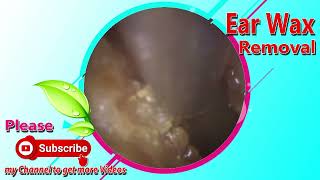 Ear Wax Removal Myths Debunked What You Need to Know 007 [upl. by Blen]