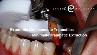 Exodontia Minimamente Traumática  Minimally Traumatic Extraction [upl. by Irab]