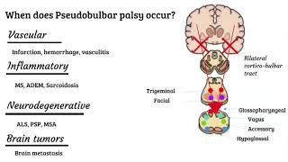 Bulbar vs pseudobulbar palsy [upl. by Peugia]