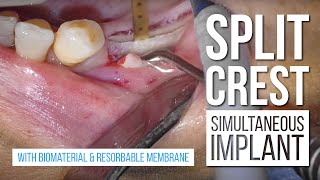 Split Crest with Simultaneous Implant with biomaterial amp resorbable membrane [upl. by Jar]