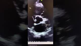 Bicuspid aortic valve echo [upl. by Marice520]