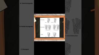 Classification of Lisfranc Injuries lisfranc ortholectures orthopaedics orthodoc ortho [upl. by Luht]