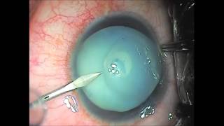 Capsulorhexis Million Dollar in Hypermature Cataract [upl. by Ariem]