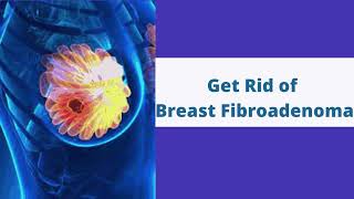 Breast Fibroadenoma Treatment Without Surgery in Hyderabad  VABB Treatment [upl. by Alekin924]