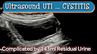 Cystitis  UTI  Ultrasound  Diagnosis [upl. by Ithsav]