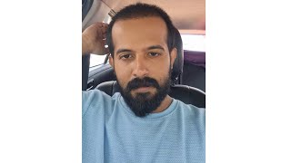 Going For Third Prp After Hairtransplantation LaDensitae Hair Transplantation Results🤍Subscribe Me [upl. by Terese]