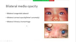 Amblyopia Awakening Redefining Management Approaches [upl. by Ehrsam]