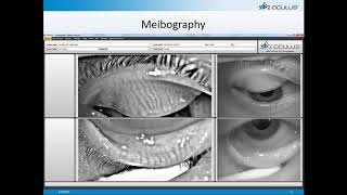 Online Seminar Chad Overman Tips for Practice Building with Your Keratograph® 5M [upl. by Tewell230]