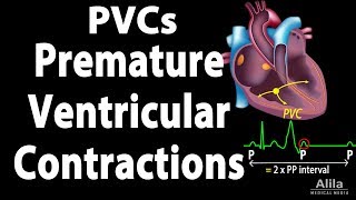 Premature Ventricular Contractions PVCs Animation [upl. by Esimaj]