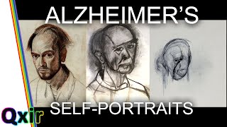 Artist With Alzheimers Disease Draws Himself as Condition Progresses [upl. by Neiht356]