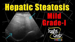 Mild Hepatic Steatosis  GradeI Fatty Liver  Ultrasound  Case 230 [upl. by Avril343]