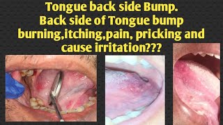 Tongue back side Bump back side of Tongue bump burningitchingpain pricking and cause irritation [upl. by Nailuj]