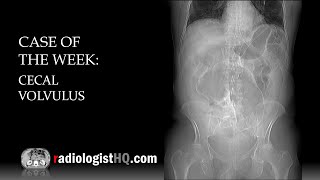 Case of the Week Cecal Volvulus Xray amp CT [upl. by Cadmann227]