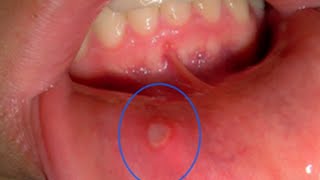 Oral Mucocele  Causes and Treatment [upl. by Allisurd]