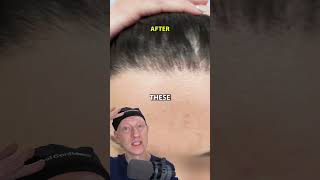 How I Got An INCREDIBLE Hairline Lowering Result [upl. by Wetzell481]