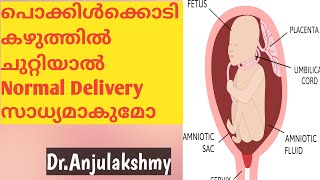 Umbilical Cord Around NeckMalayalamDrAnjulakshmy [upl. by Cerveny]