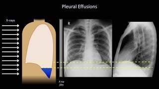 How to Interpret a Chest XRay Lesson 6  Diaphragm and Pleura [upl. by Annodahs]