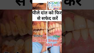 पीले दांत को फिर से सफेद करें teethwhitening teethfilling stainteeth dentalcap yellowteeth drr [upl. by Dora929]