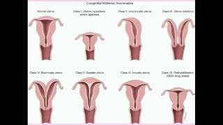 Congenital Uterine Abnormalities  CRASH Medical Review Series [upl. by Ahsemit]