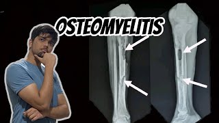 Osteomyelitis  Causes Pathogenesis Complications and Pathophysiology Bone Infection pathology [upl. by Nodababus]