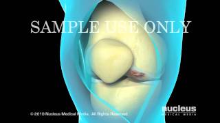 Total Knee Joint Replacement Surgery [upl. by Claudetta502]