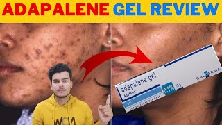 Adapalene Gel Adaferin 01 Review In Hindi  Best Gel For Removing Blackheads and Whiteheads [upl. by Burkle]