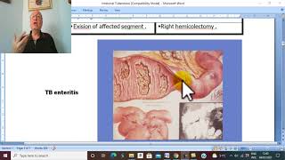 Intestinal Disorders in Arabic 4  intestinal TB   by Dr Wahdan [upl. by Eiralam]