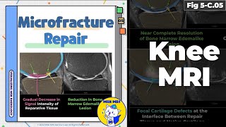 Fig 5C05 MRI Findings of Microfracture Repair [upl. by Andromada392]