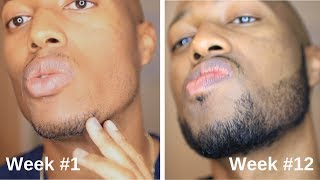 Minoxidil Beard Journey 3 Month Transformation [upl. by Nitsraek471]