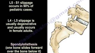 SpondylolysisSpondylolisthesisSpondylitis Spondylosis EverythingYou Need To Know Dr Nabil Ebraheim [upl. by Ambrosine]