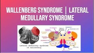 Wallenberg Syndrome  Lateral Medullary Syndrome  PhysiotherapyKnowledge [upl. by Echo]