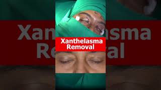 XANTHELASMA Removal Treatment At Shobhit Aesthetics [upl. by Bonnice]