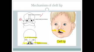 How cleft lip and cleft palate occurs For USMLE step 1 [upl. by Treve]